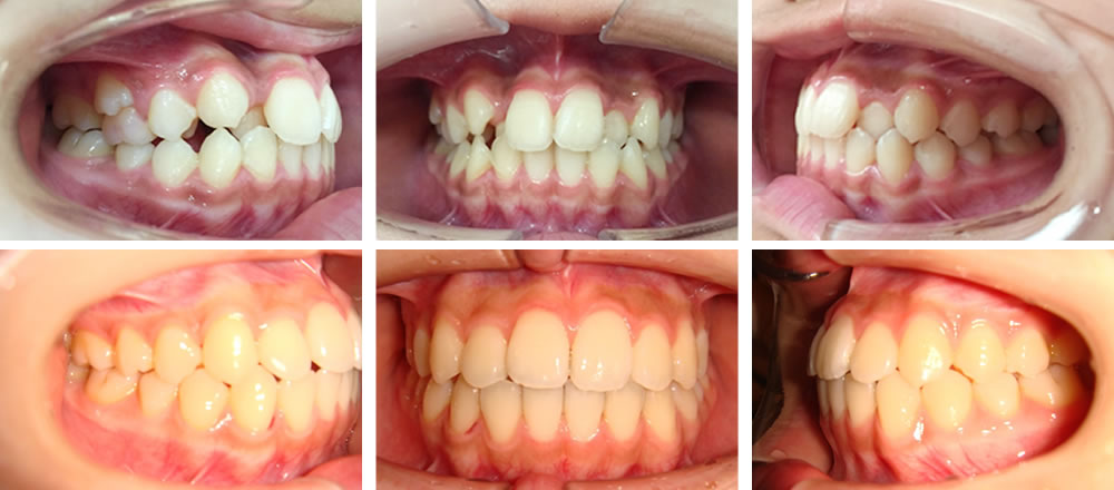 子どもの叢生の矯正治療例