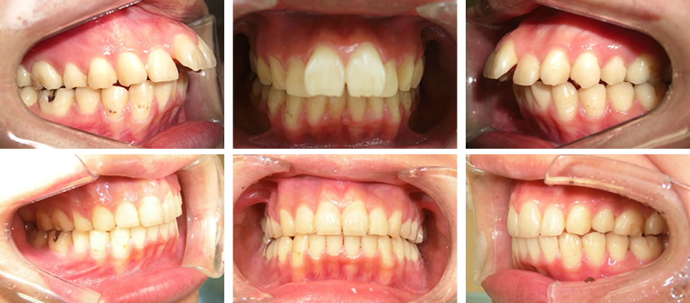 八重歯の矯正治療例