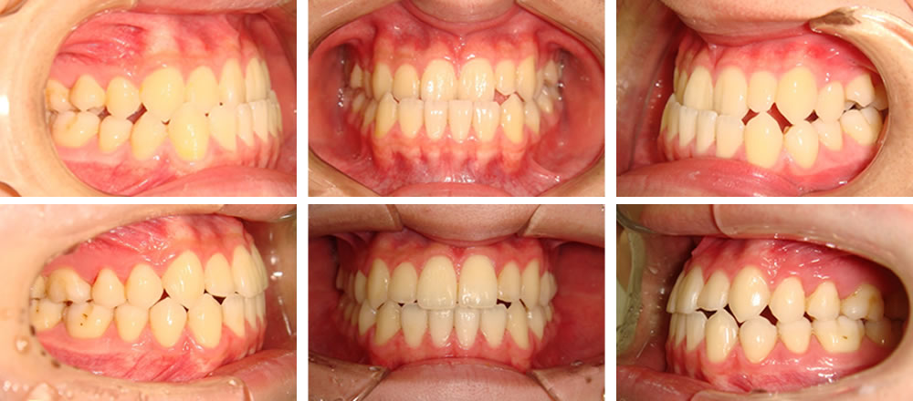 八重歯の矯正治療例
