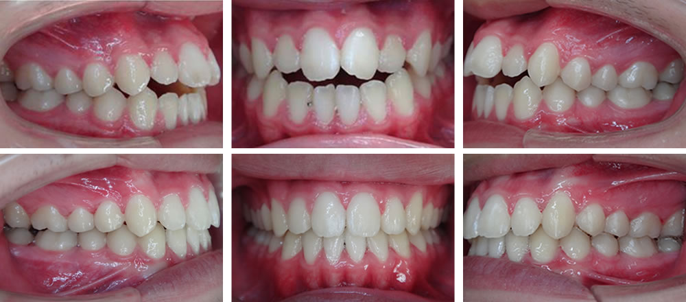 八重歯の矯正治療例