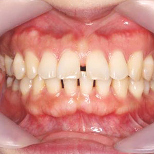 子供のすきっ歯の歯科矯正治療例