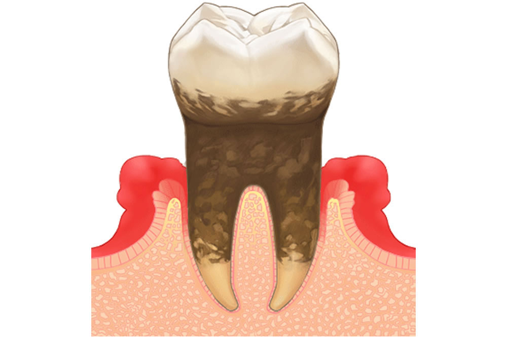歯茎の炎症・歯周病