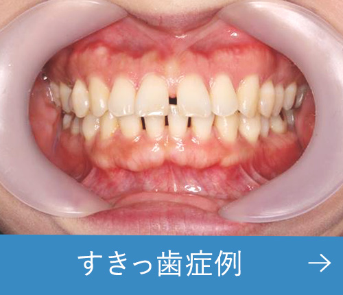 歯科矯正学 10代 男性 マルチブラケット 開咬 | 院長ブログ（症例集）｜ワダ